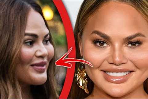 Top 10 Celebrities Who DESTROYED Their Face With Filler